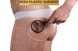 39.90€ Συνεδρία ενός ατόμου HIFU-MAX Body Contouring σε μια περιοχή του σώματος της επιλογής σας, στο “Deka Plastic Surgery” στην Ερμού. Ιδανική θεραπεία για γυναίκες & άνδρες!!